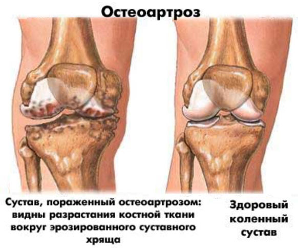 Остеоартроз коленного сустава картинка.
