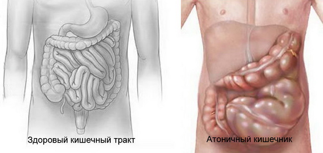 сравнение здорового и атонического кишечника
