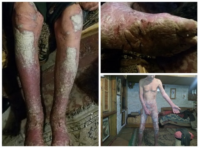 ладонно подошвенный псориаз лечение грязью Сиваш в домашних условиях, фото до лечения