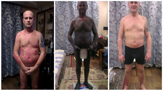 фото до, во время и после лечения псориаза лечебной грязью Сиваш в домашних условиях
